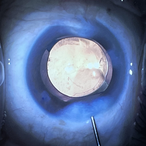 close up of cataract surgery